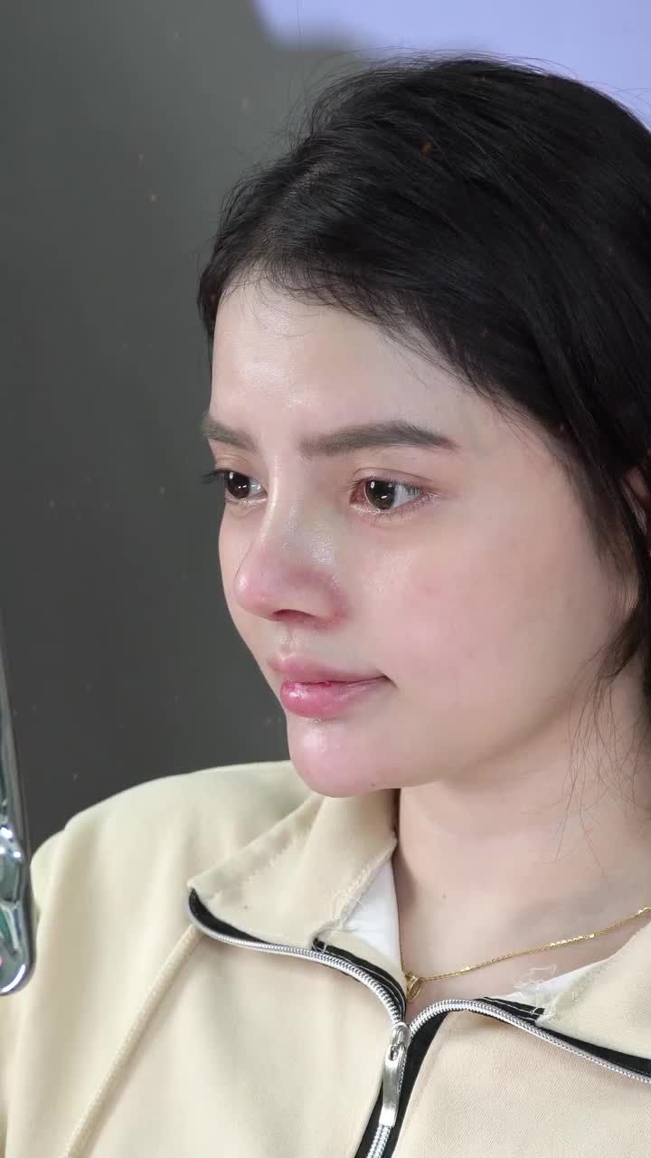 DÁNG MŨI SAU 7 NGÀY THÁO NẸP – ĐÃ ĐẸP TỰ NHIÊN