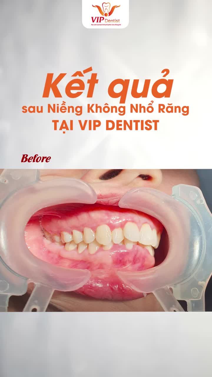NIỀNG RĂNG KHẮC PHỤC MỌI TÌNH TRẠNG RĂNG SAI LỆCH, SAI KHỚP CẮN