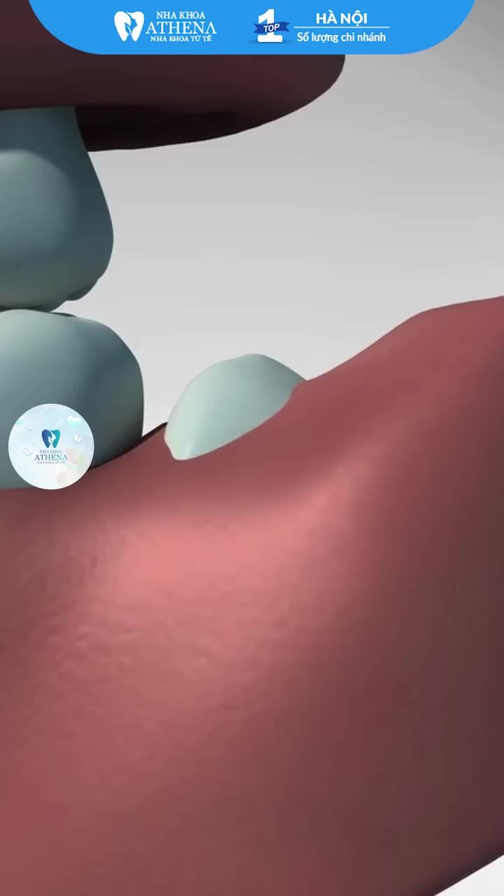 Răng khôn mọc lệch – xử lý thế nào?