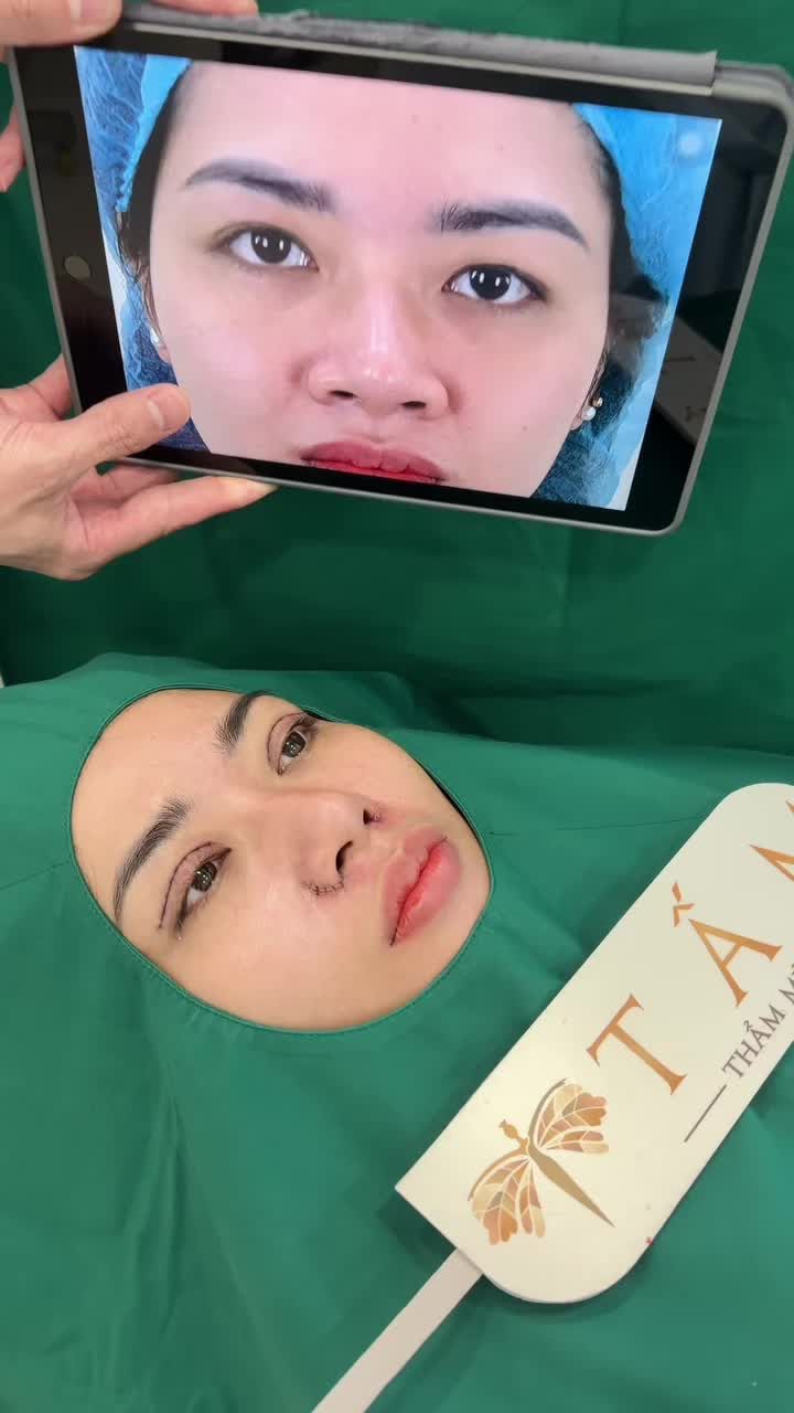 Kết quả sau khi thực hiện combo cắt mí và thu gọn cánh mũi cho chị khách hàng tại nhà Tấm. Cả nhà chấm bao nhiêu điểm nè!