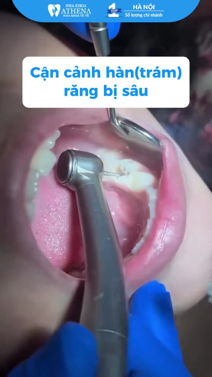 Cận cảnh trám răng sâu
