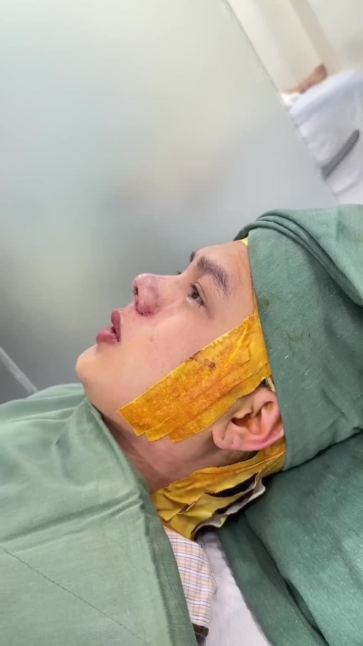 NAM GIỚI SAU KHI NÂNG MŨI SẼ NHƯ THẾ NÀO???