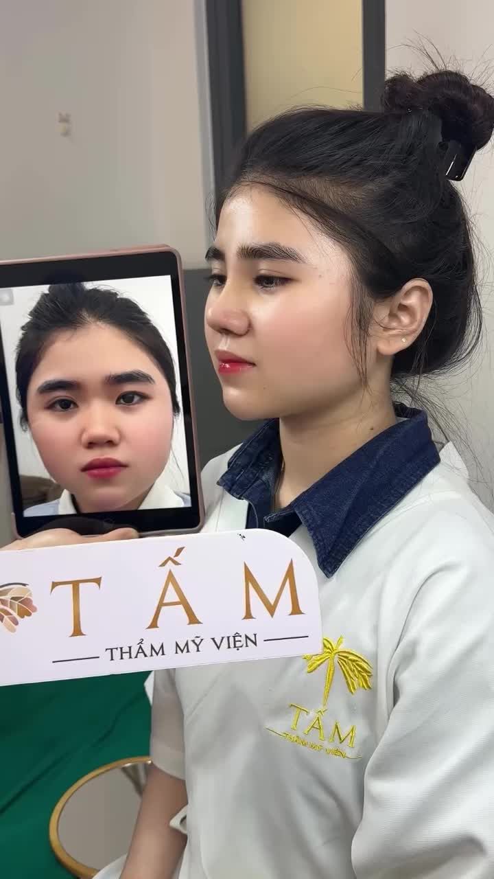 Sống mũi thấp, hếch, cánh mũi to bè – 7 ngày sau cắt chỉ đã “lên form” rõ rệt. Cùng xem kết quả của bạn khách hàng trong video