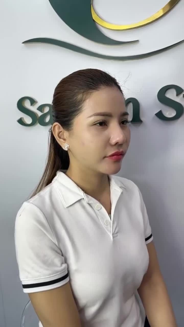 GẶP GỠ KHÁCH HÀNG SAU HƠN 2 THÁNG NÂNG MŨI CẤU TRÚC DR. HOẠT