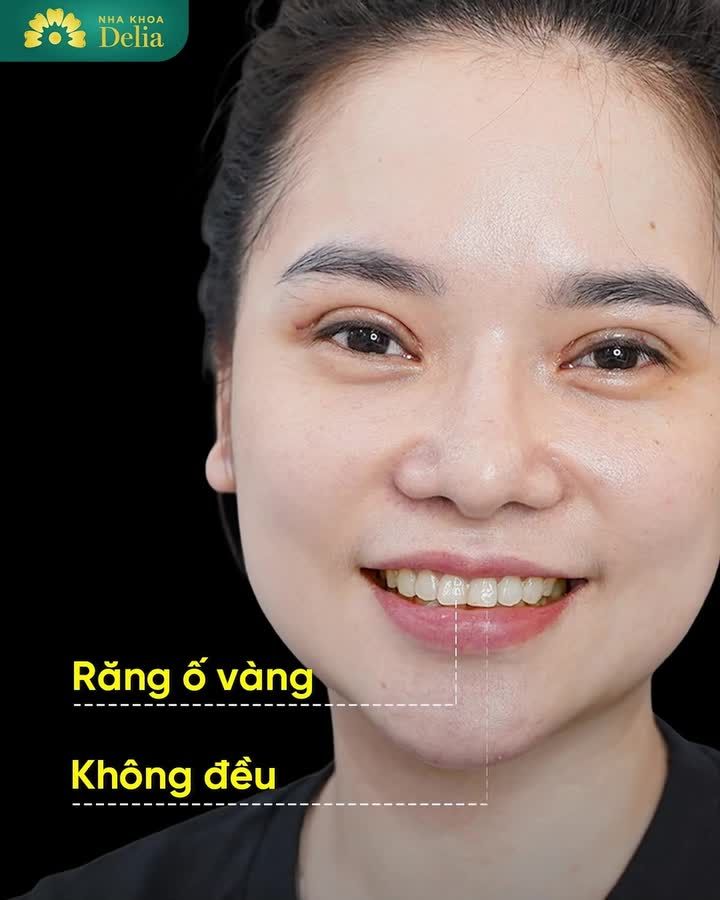 Thẩm mỹ răng sứ không phải cứ làm giống bất kỳ ai là đẹp, mà quan trọng phải là dáng răng, màu sắc phù hợp với mình