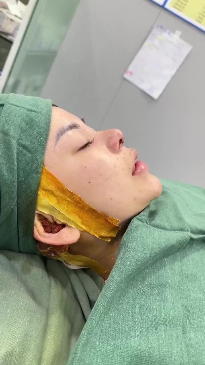 TRẢ KẾT QUẢ SAU 60 PHÚT THỰC HIỆN NÂNG MŨI CẤU TRÚC DR. HOẠT CHO KHÁCH HÀNG 2K5