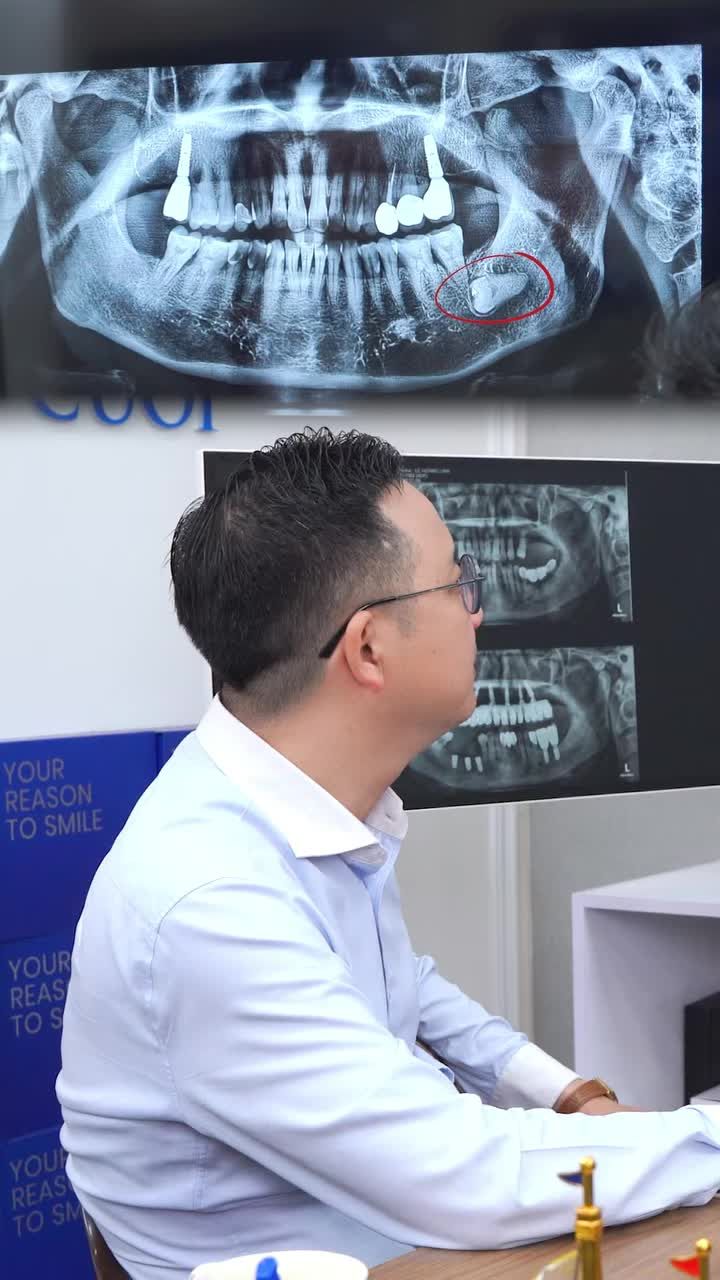 RĂNG 8 NHỔ SAI - TÁC HẠI KHÔN LƯỜNG!