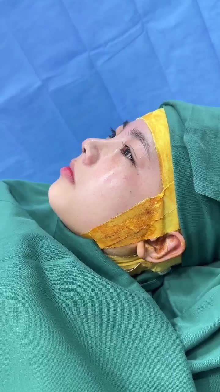 TRẢ KẾT QUẢ NÂNG MŨI CẤU TRÚC DR. HOẠT CHO BẠN KHÁCH GEN Z ĐẾN TỪ CÀ MAU