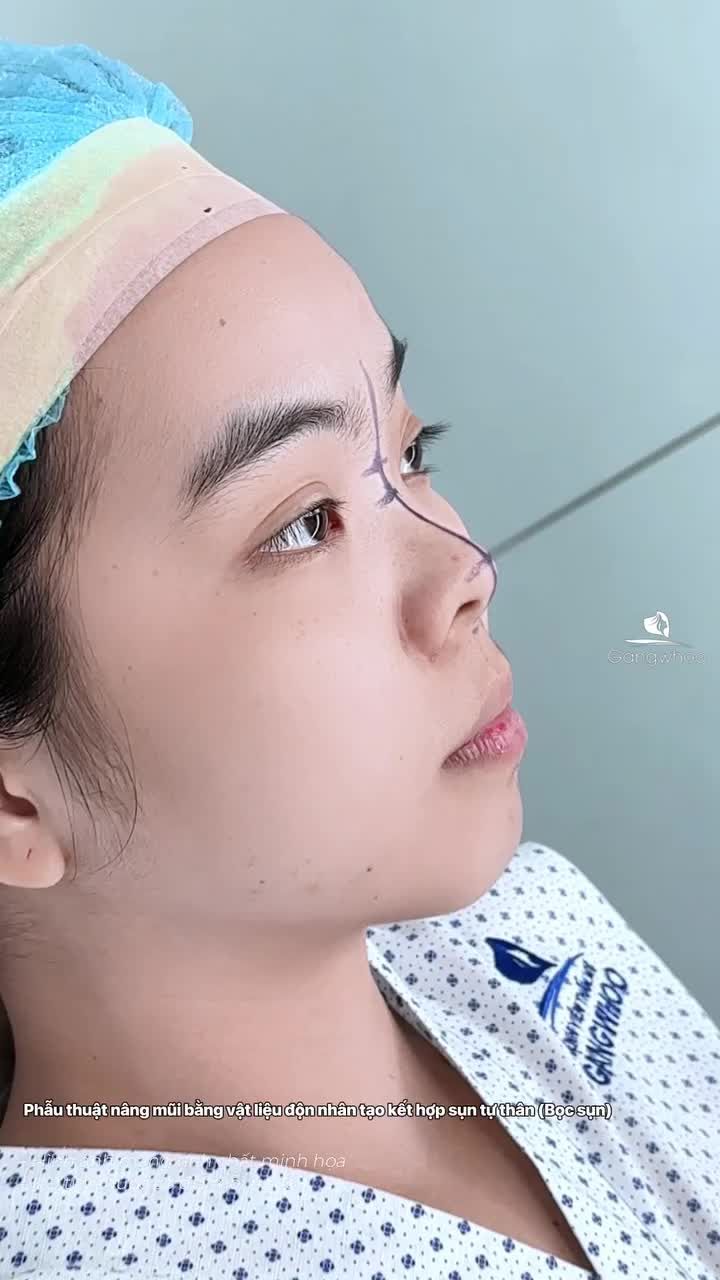 60 phút nâng mũi kết thúc 22 năm tự ti