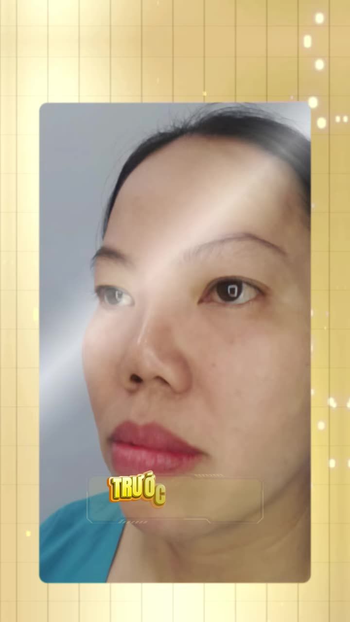 Có nên làm combo mũi cùng một lúc?