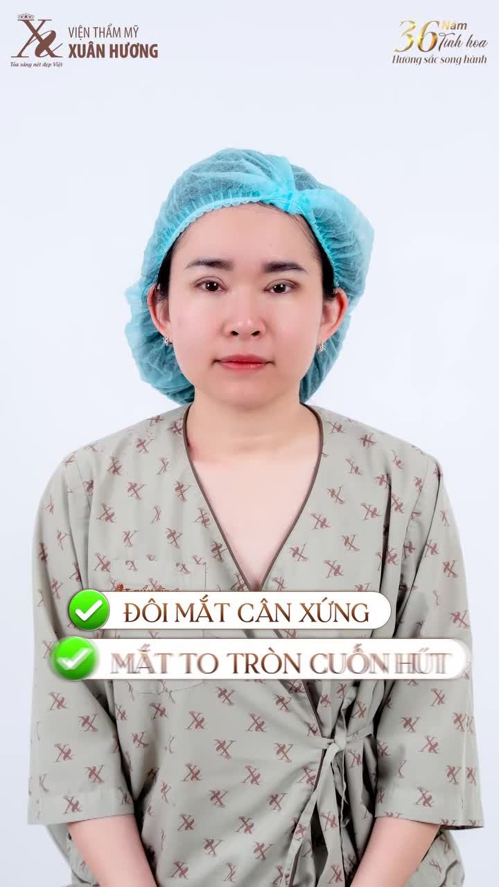 CẮT MÍ TRÊN – MỞ GÓC MẮT KHÔNG ĐAU KHÔNG SẸO ĐẸP TỰ NHIÊN CHỈ 40 PHÚT