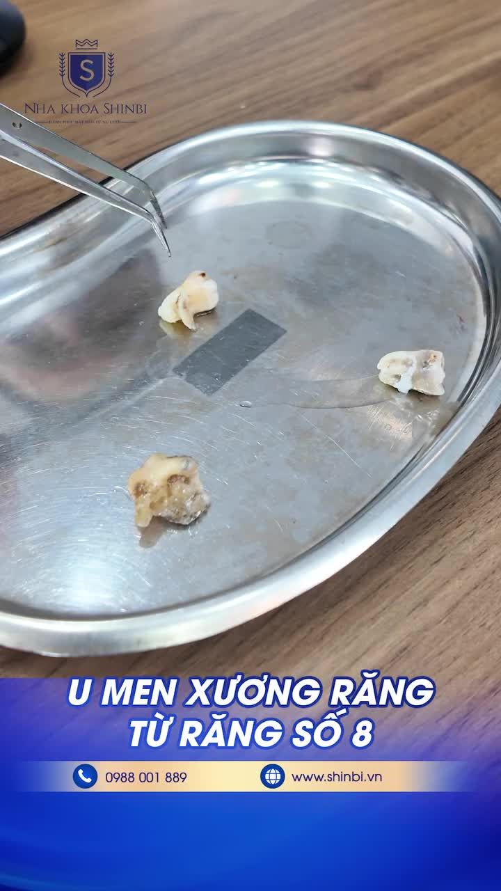 U MEN XƯƠNG RĂNG TỪ RĂNG SỐ 8 ?