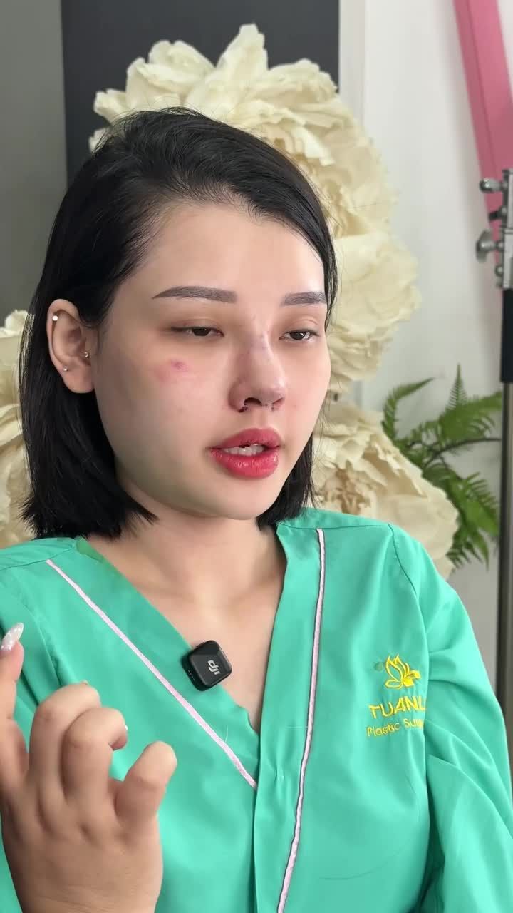 NÂNG MŨI CẤU TRÚC SỬA LẠI - TÁI TẠO FORM DÁNG ĐẸP CHUẨN TỪNG MILIMET!!