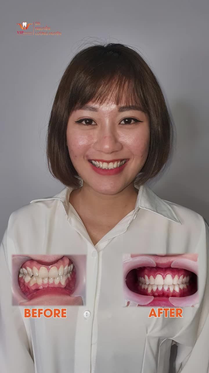 Khách hàng đã thay đổi thế nào sau phác đồ “Niềng Răng Không Nhổ Răng” tại VIP Dentist?