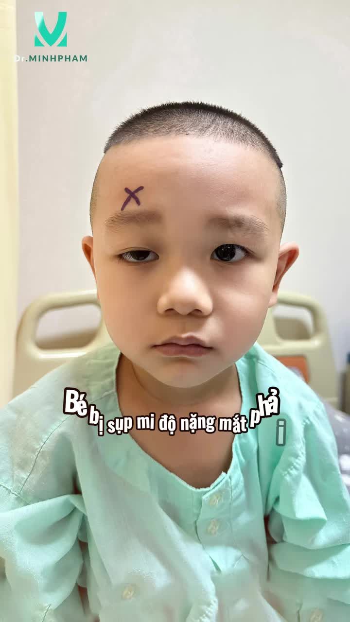 Feedback bé Nhật Minh sau 4 tháng phẫu thuật treo mi vạt cơ trán tại Dr. Minh Phạm