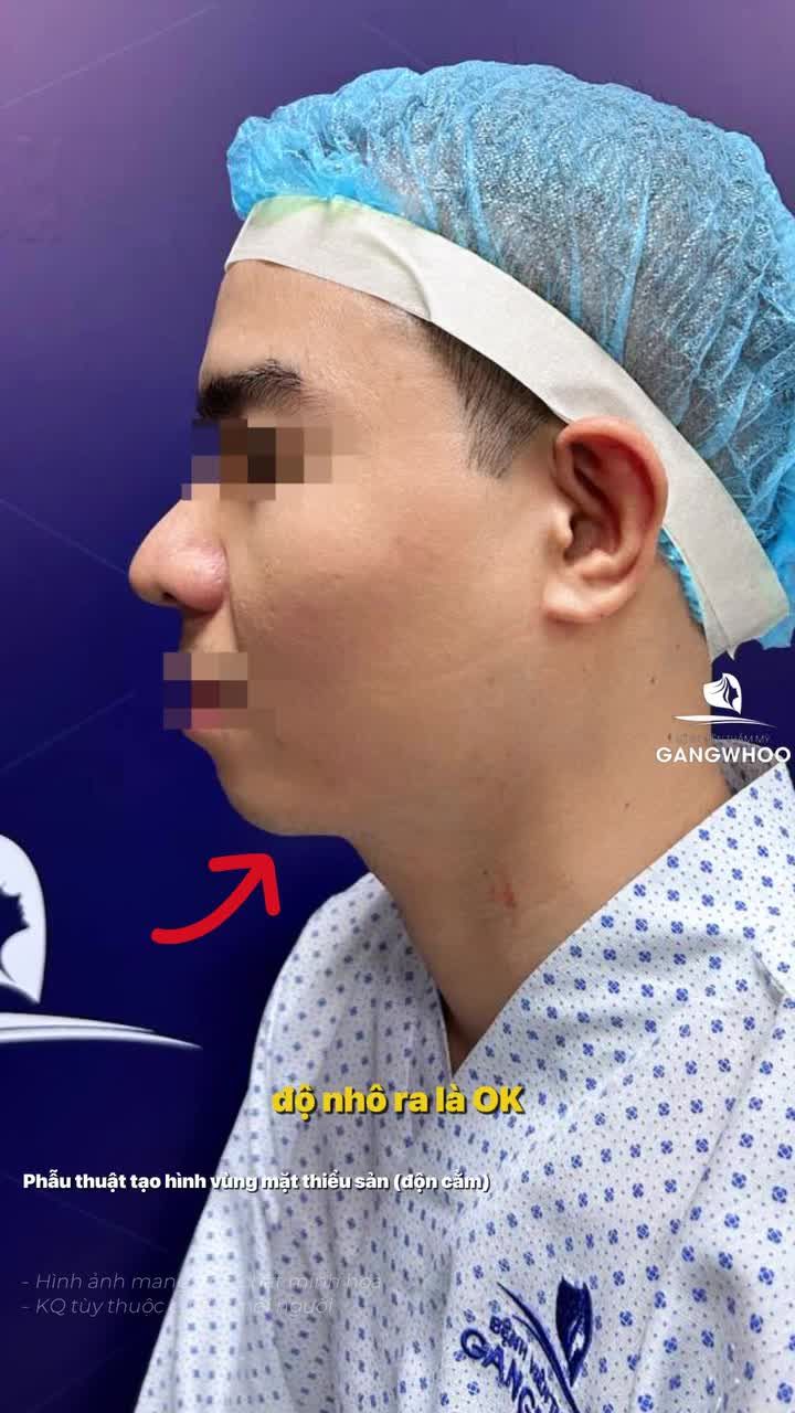 Một chiếc cằm mới,  một diện mạo hoàn toàn khác