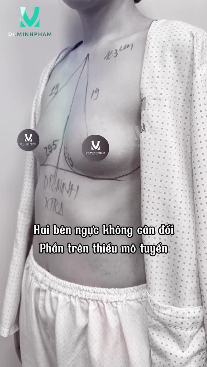 Kết quả nâng ngực tại Dr. Minh Phạm