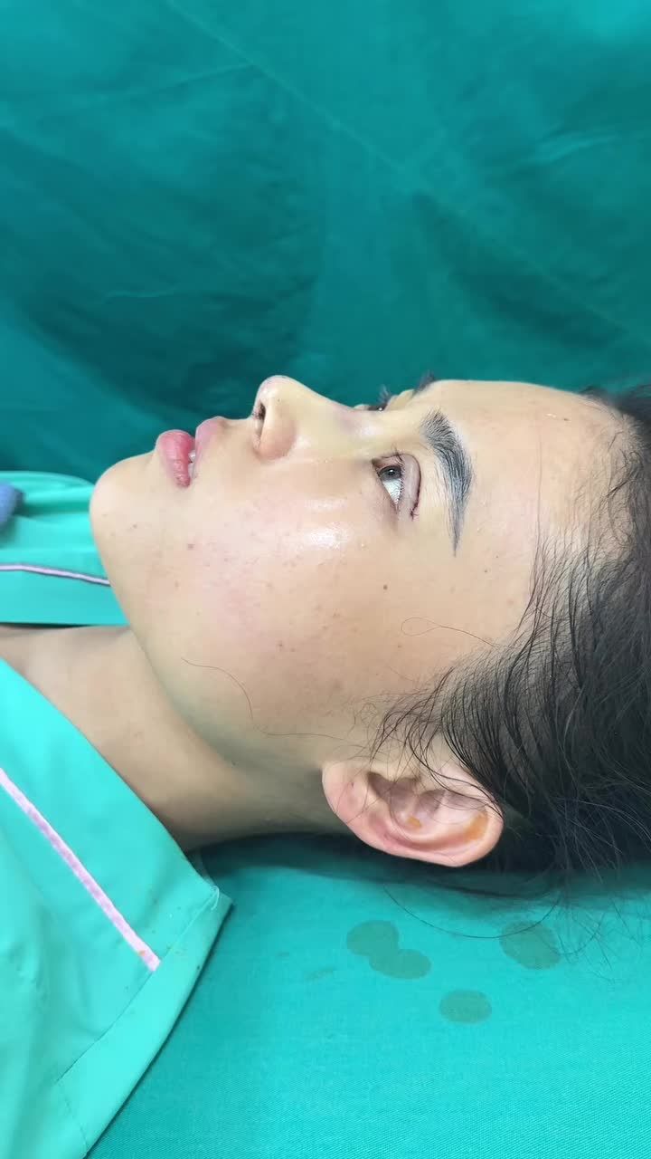 Ca combo nâng cấu trúc và cắt mí