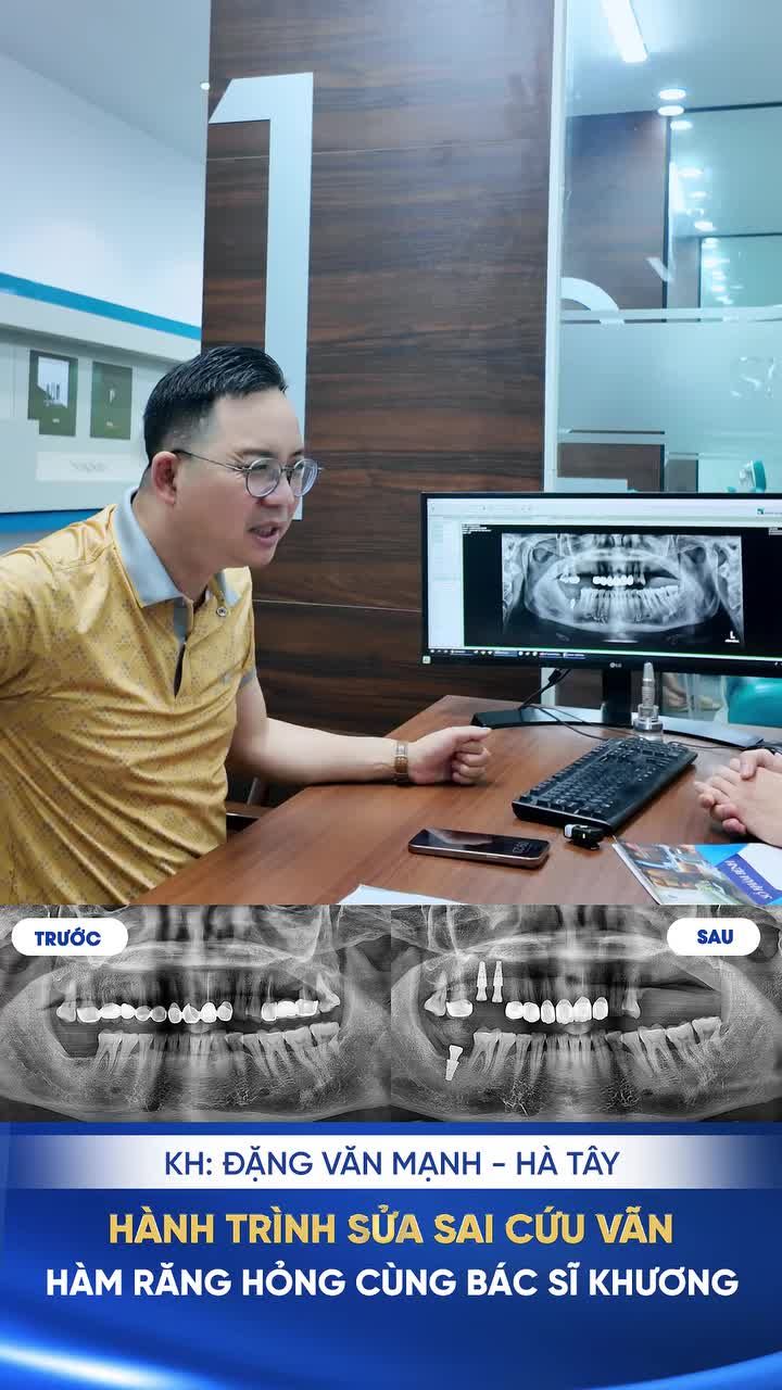 Mọi người thường nghĩ cắm Implant phải chọn loại của Mỹ, Đức, Thụy Sĩ mới xịn.  Nhưng sự thật là: Xương của bạn cần gì thì đó mới là lựa chọn đúng.