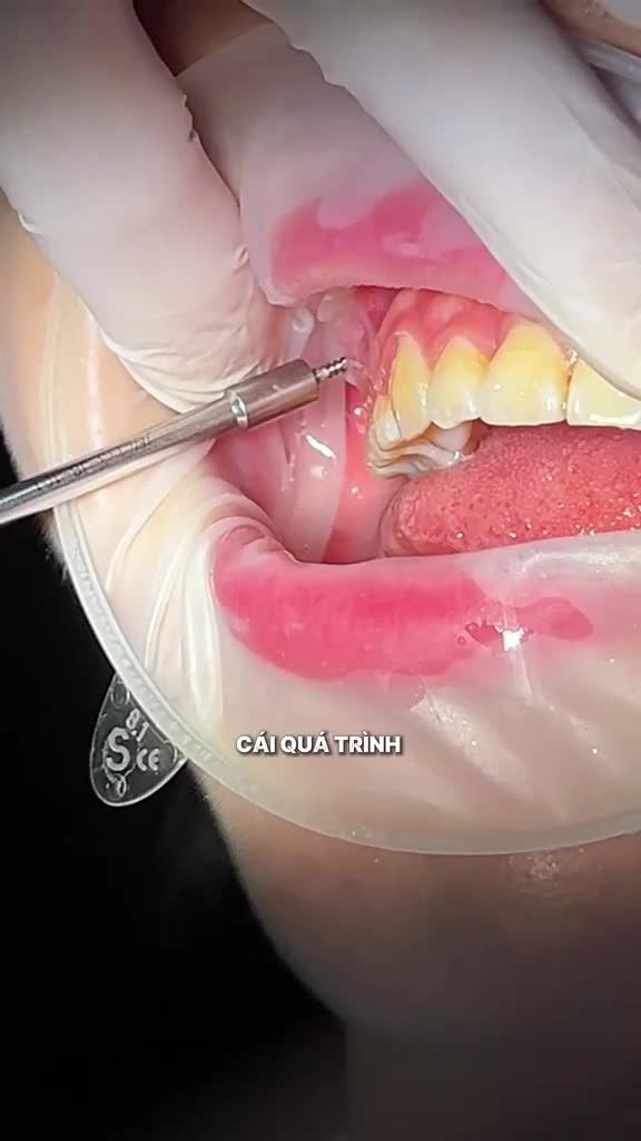 Cận cảnh quy trình tháo vis nhẹ nhàng chỉ trong "vài nốt nhạc" tại Viet Smile