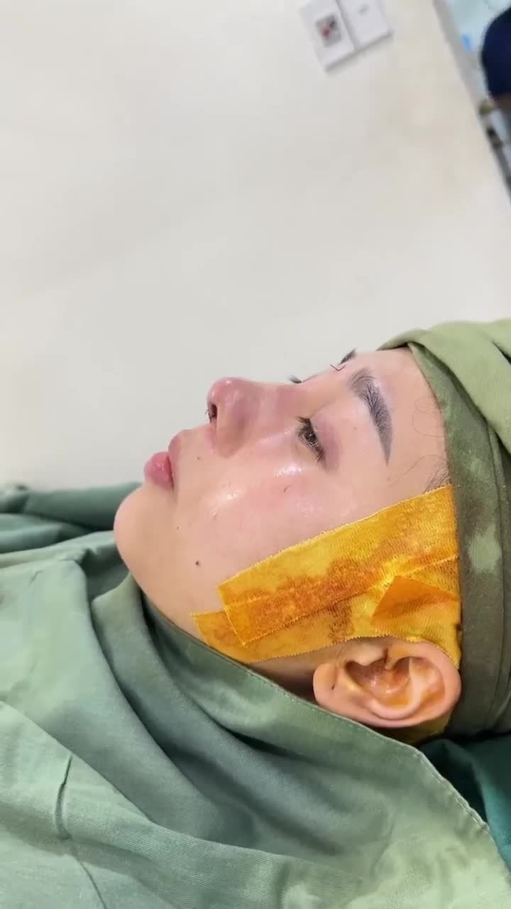 KẾT QUẢ SAU 60 PHÚT NÂNG MŨI CẤU TRÚC DR. HOẠT KH. TUYẾT NHI (AN GIANG)