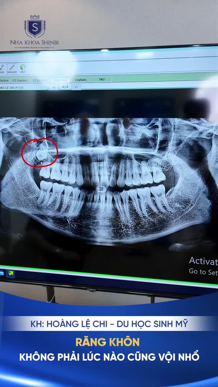 "RĂNG KHÔN KHÔNG PHẢI LÚC NÀO CŨNG "VỘI" NHỔ "