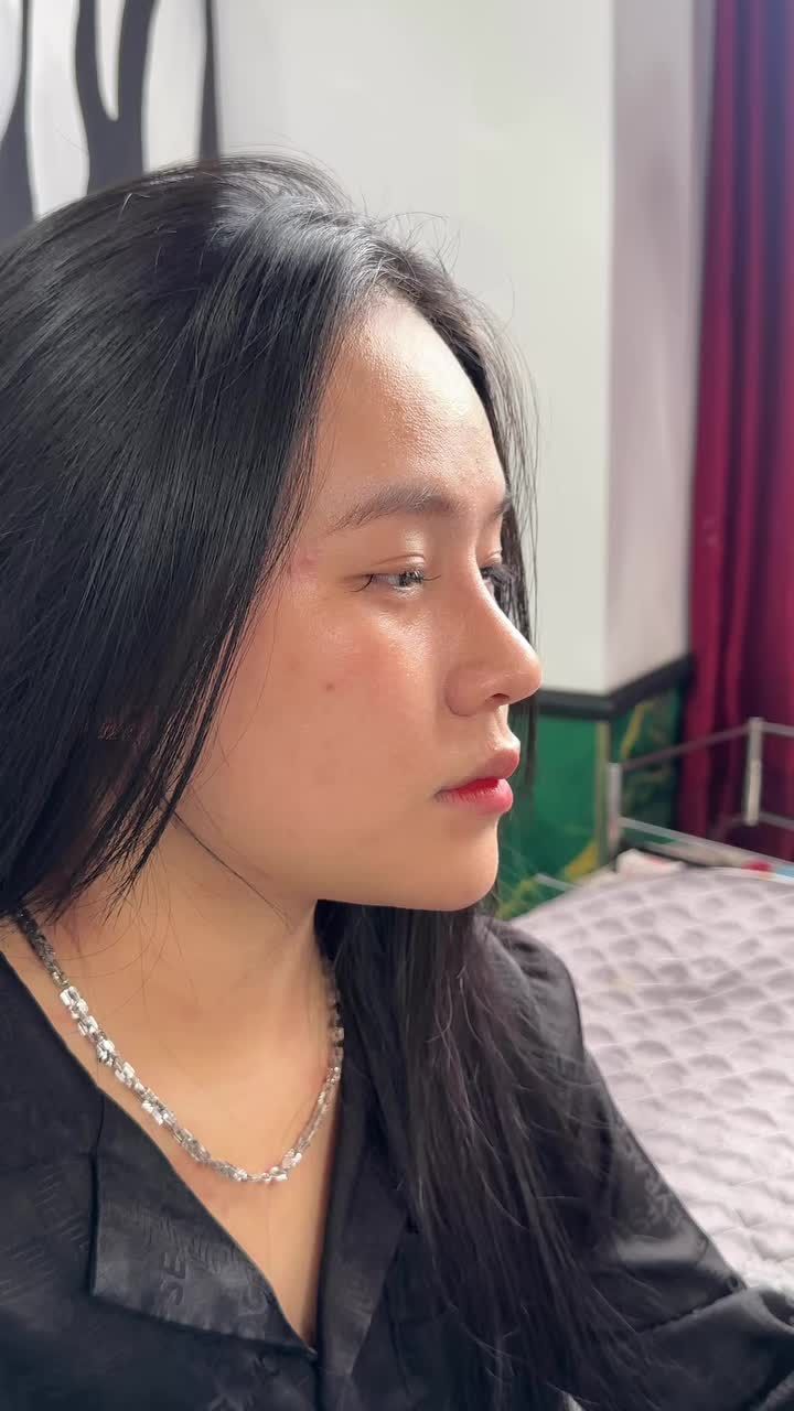 Mũi cấu trúc sau 10 ngày