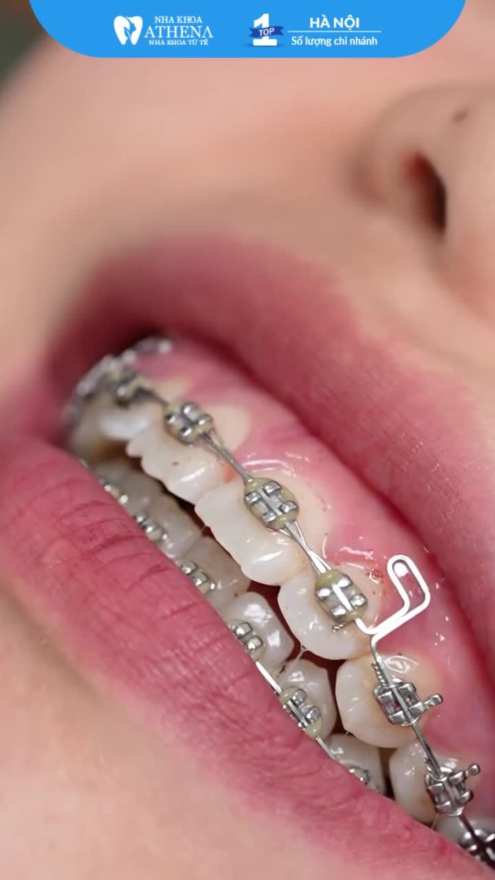 “GIẢI MÃ” TÌNH TRẠNG HÓP MÁ KHI NIỀNG RĂNG