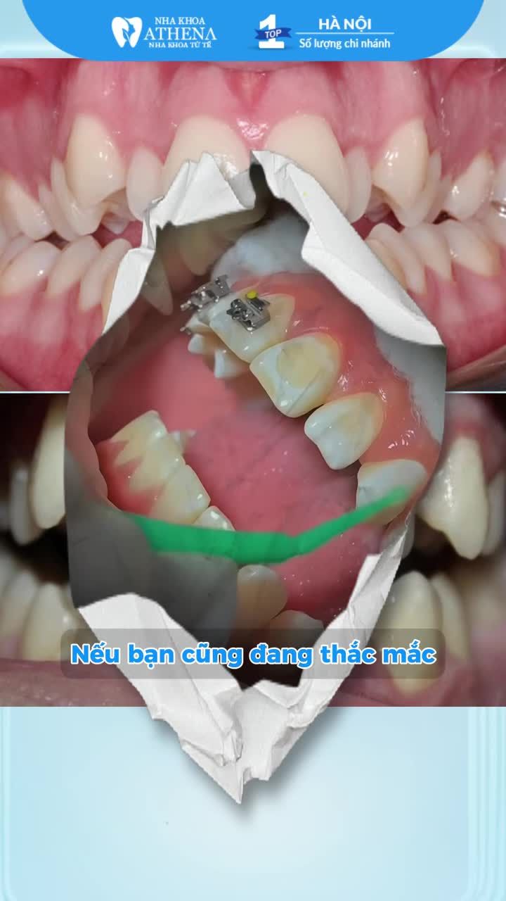 RĂNG KHÔNG ĐỀU, CHEN CHÚC – CÓ THỂ NIỀNG INVISALIGN KHÔNG?