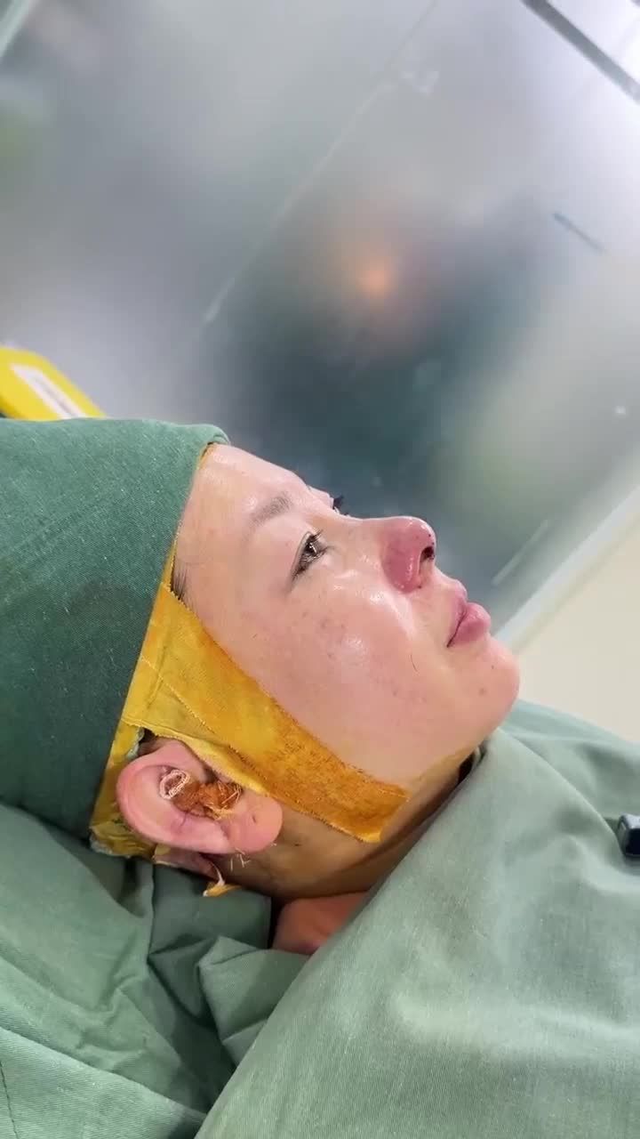 TRẢ KẾT QUẢ SAU 60 PHÚT THỰC HIỆN NÂNG MŨI CẤU TRÚC DR. HOẠT