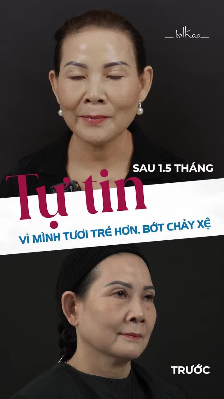 CẢM NHẬN KẾT QUẢ CỦA KHÁCH HÀNG SAU 1,5 THÁNG THỰC HIỆN 16CC FILLER MD CODES NHƯ THẾ NÀO?