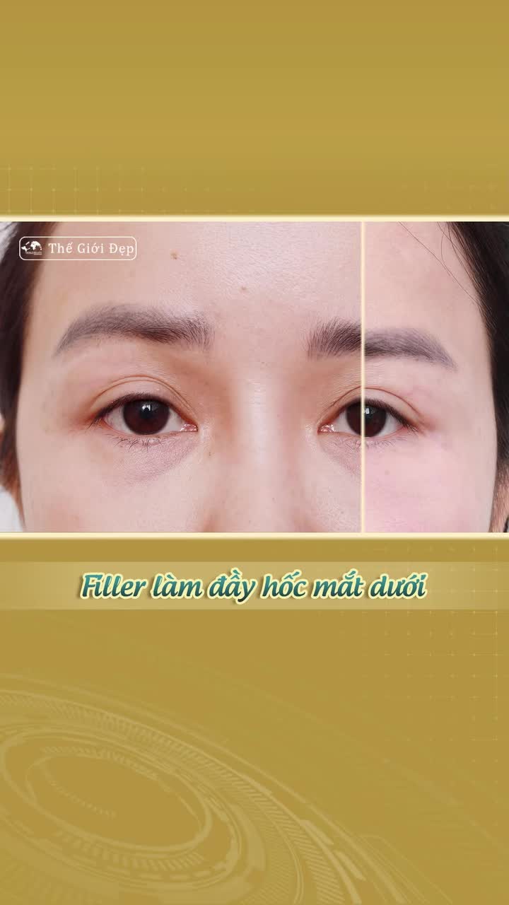 Hốc mắt trũng sâu có cải thiện được không?  Có thể cải thiện nếu được thăm khám và tư vấn đúng cách.