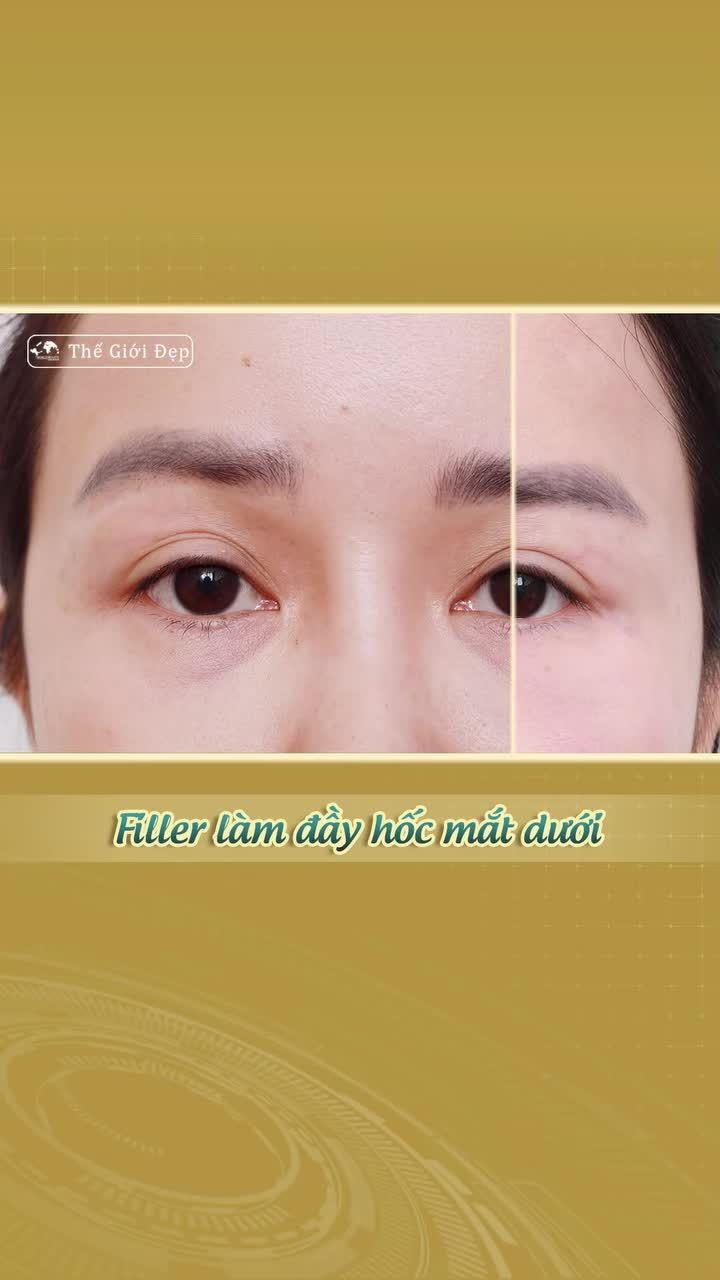 Hốc mắt trũng sâu có cải thiện được không?  Có thể cải thiện nếu được thăm khám và tư vấn đúng cách.