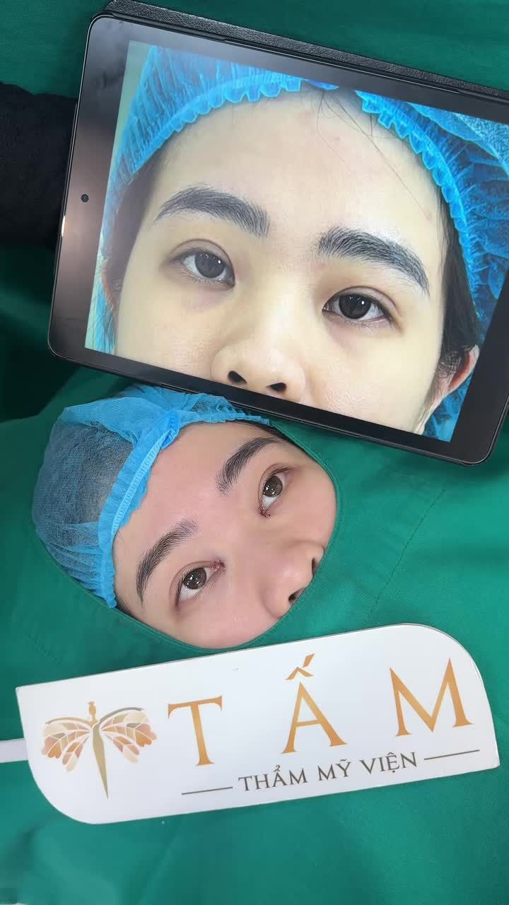 Chị khách hàng sau 2 năm cắt mí trên và cấy mỡ tại phòng khám rất ưng í, nên đã quay lại mở thêm góc mắt trong.
