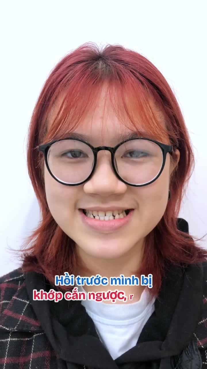 Tháo niềng đón Tết sớm với nụ cười vượt ngoài mong đợi 18 tháng niềng răng: Tự tin là phiên bản tuyệt vời nhất