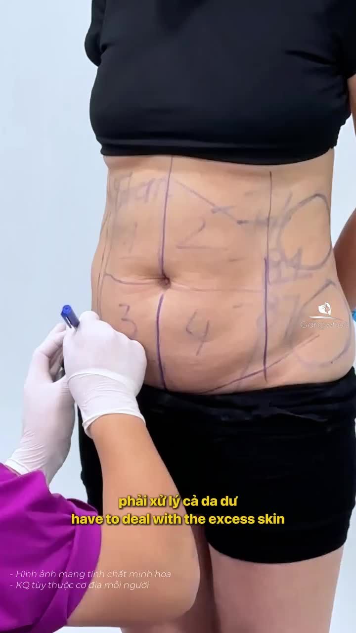 Theo chân chị khách 1 ngày đến Gangwhoo thực hiện combo giảm mỡ và căng da bụng