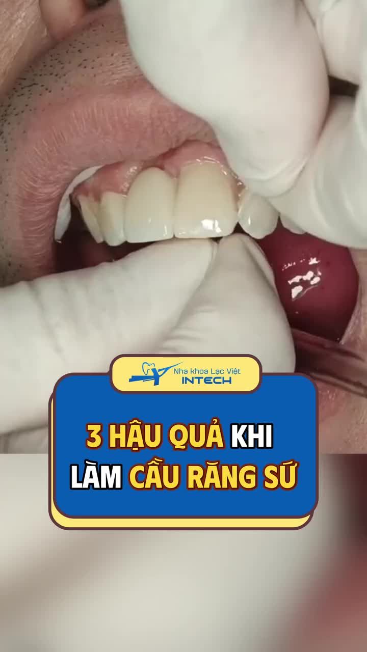 3 nhược điểm khi làm cầu răng sứ