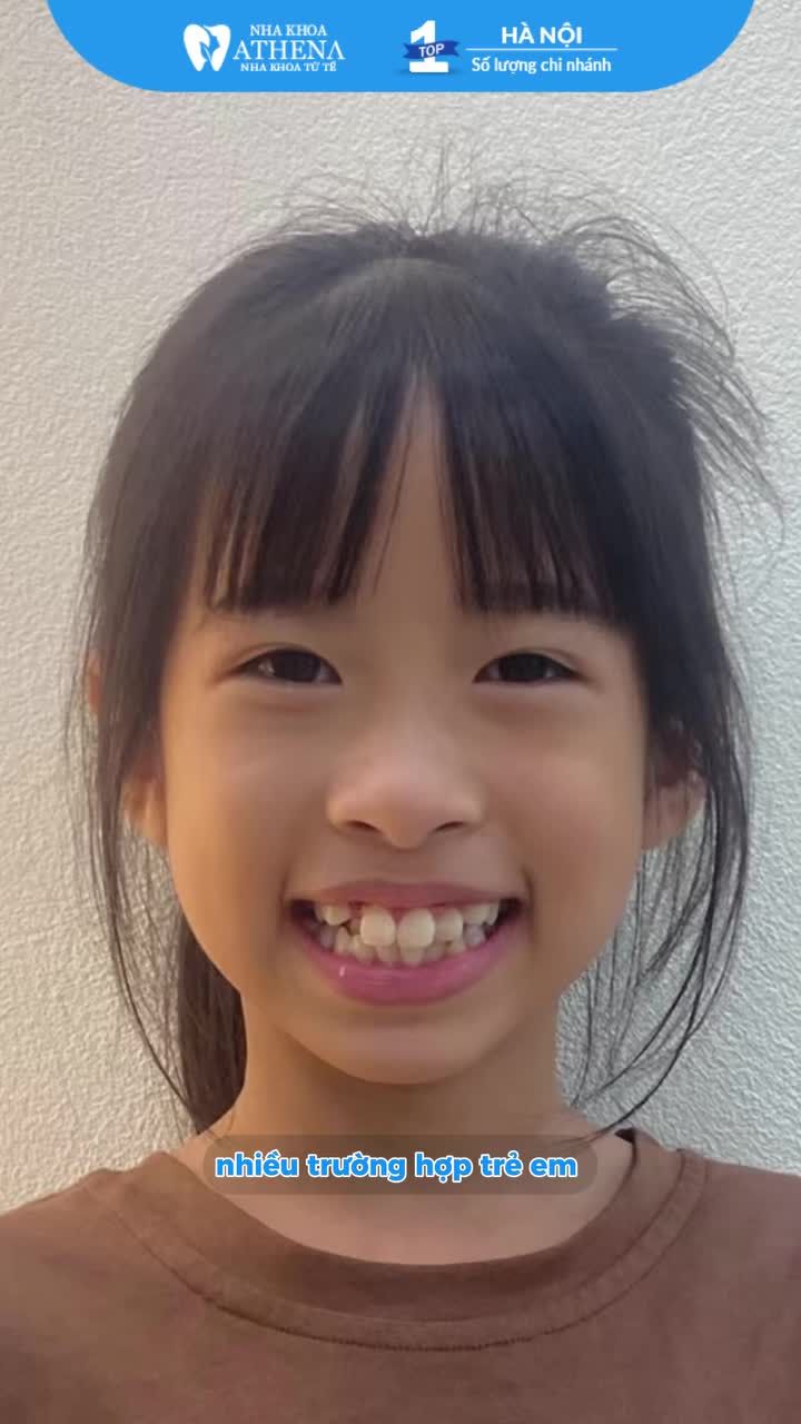 Niềng răng sớm cho trẻ – có thật sự cần thiết?