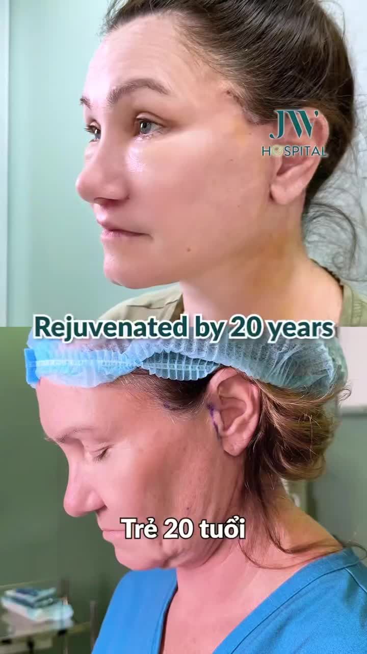 PHẪU THUẬT NHỰA CỰC PHẨM TRƯỚC SAU TRẺ RA 20 TUỔI VỚI COMBO TRẺ HOÁ TẠI BỆNH VIỆN JW