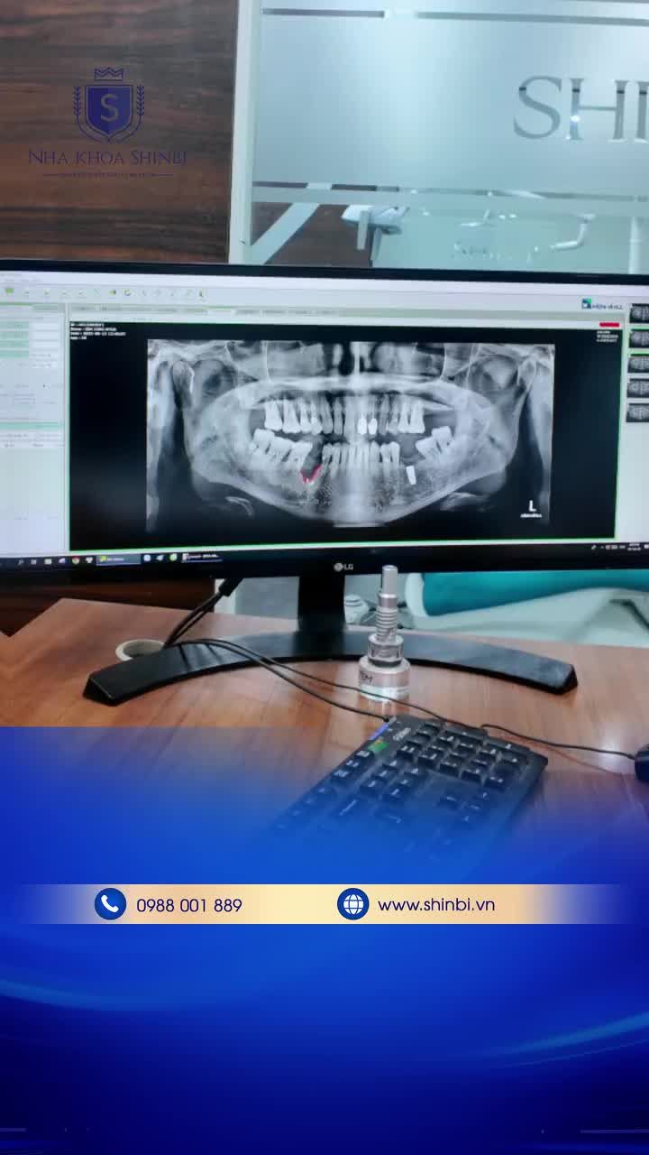 Mất răng, viêm viêm tiêu hết xương... là những nỗi đau "không lời" mà anh Kim Jong Huyk - 61 tuổi làm công nghệ thông tin, người Hàn Quốc đã phải chịu đựng suốt thời gian qua.