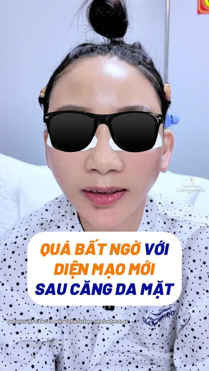Quá bất ngờ với kết quả thay đổi toàn diện gương mặt sau phẫu thuật căng da mặt toàn phần + Smas nội soi 4K