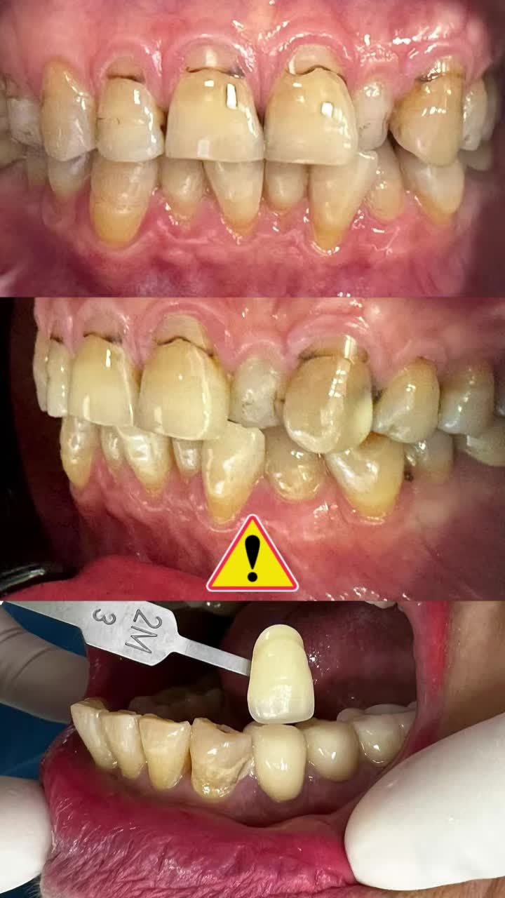 HÀI LÒNG MỸ MÃN VỚI NỤ CƯỜI MỚI Cô Hương chấm điểm 10/10 cho Nha khoa Paris