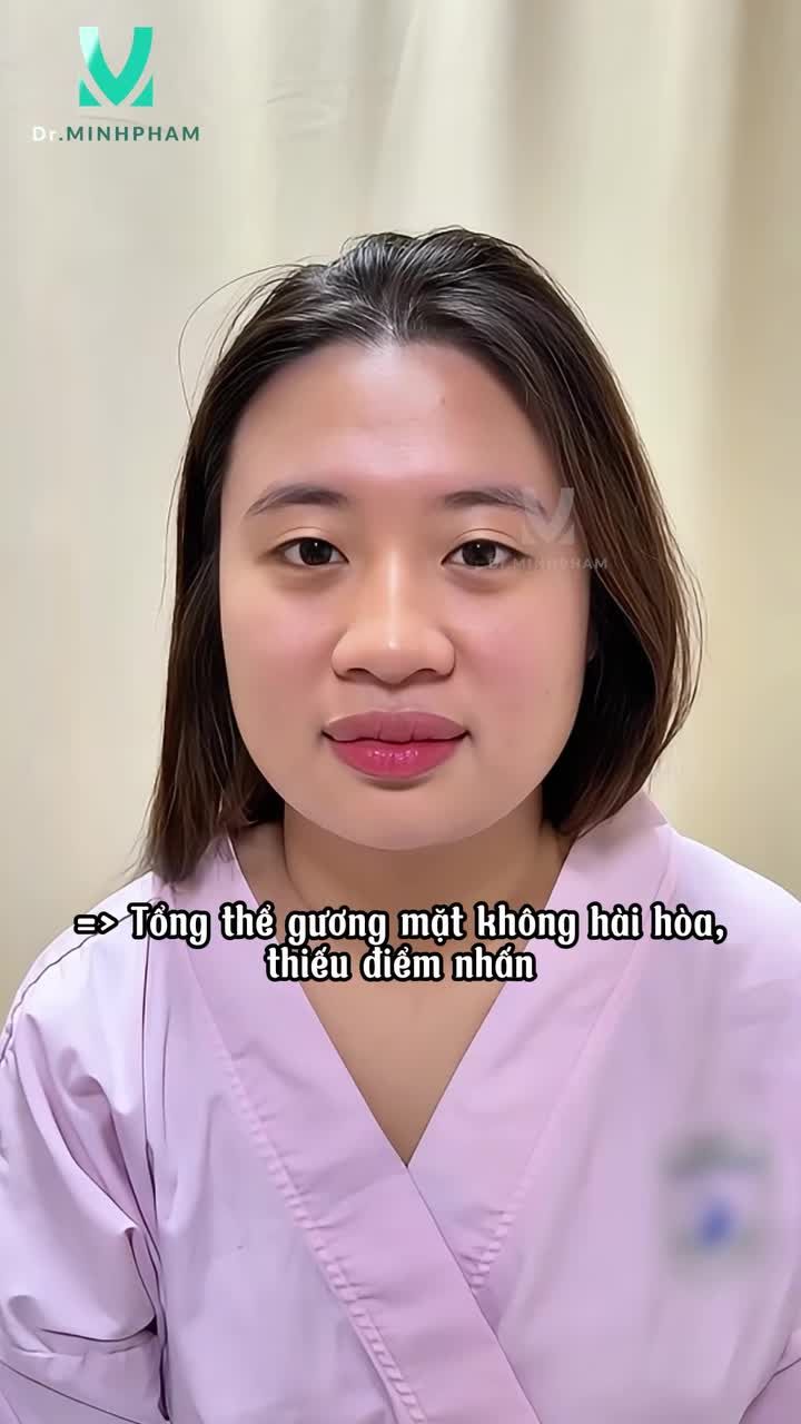 Cắt mí kết hợp tạo hình môi trên – Thay đổi chỉ trong 1 lần thực hiện