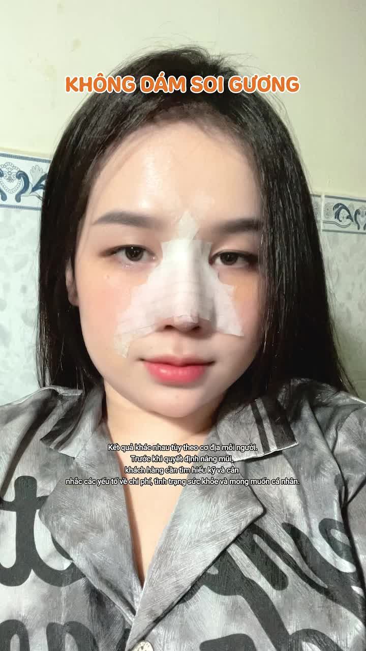 Có thể bạn sẽ chưa hài lòng trong 1-2 tuần sau nâng mũi, vì sao?