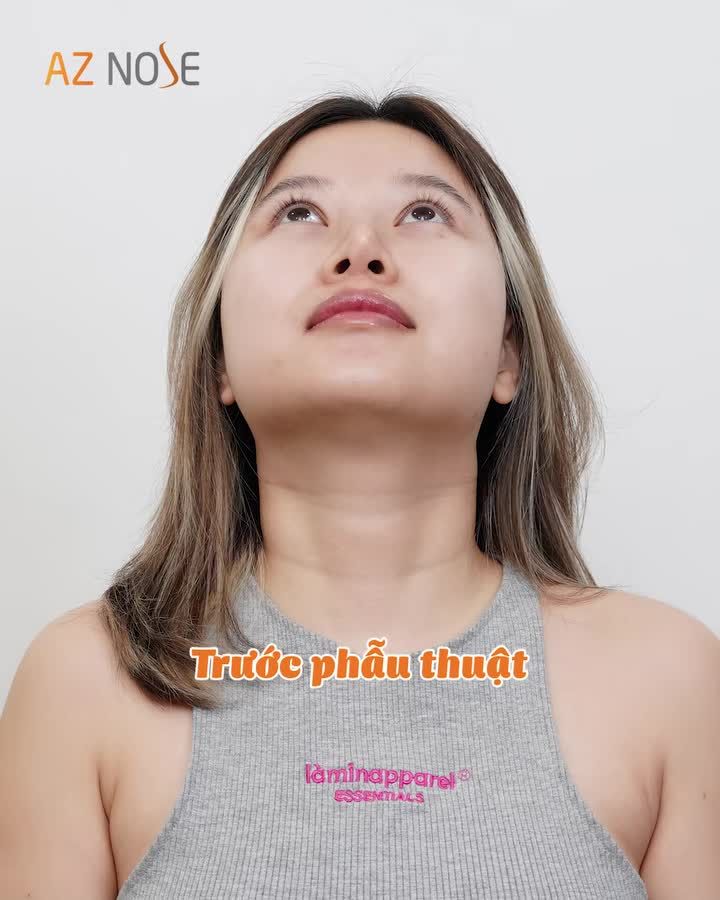 Sau 2 tháng tái tạo mũi hỏng tại AZ NOSE, diện mạo và cuộc sống của chị H.H. đã thay đổi như thế nào?