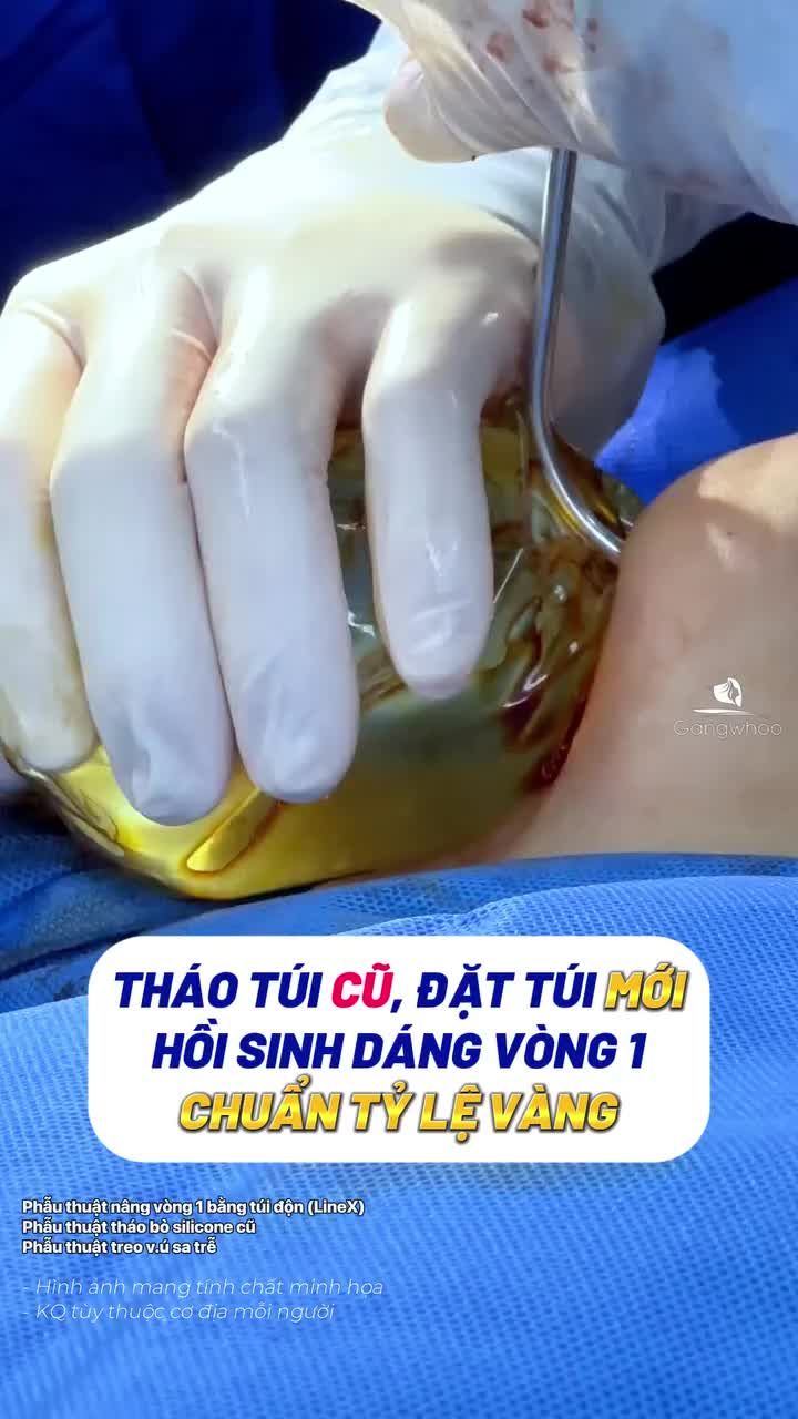 Tháo túi ngực cũ, đặt túi ngực mới, lấy lại dáng vòng 1 chuẩn tỷ lệ vàng cho chị khách hàng người Úc đã đặt túi cách đây 10 năm