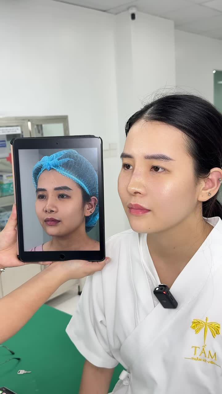 Nâng mũi Sau 10 ngày sẽ thay đổi như thế nào? Cùng trực tiếp theo dõi kết quả của khách hàng sau 10 ngày nâng mũi tại Tấm.