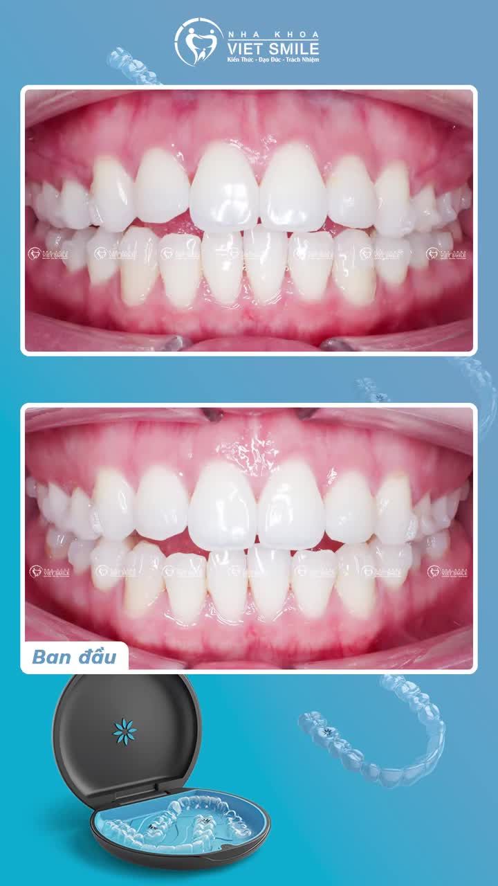 Invisalign đã thay đổi răng cắn hở như thế nào?