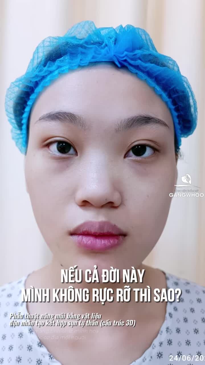 Nâng mũi để xinh đẹp và rực rỡ theo cách riêng