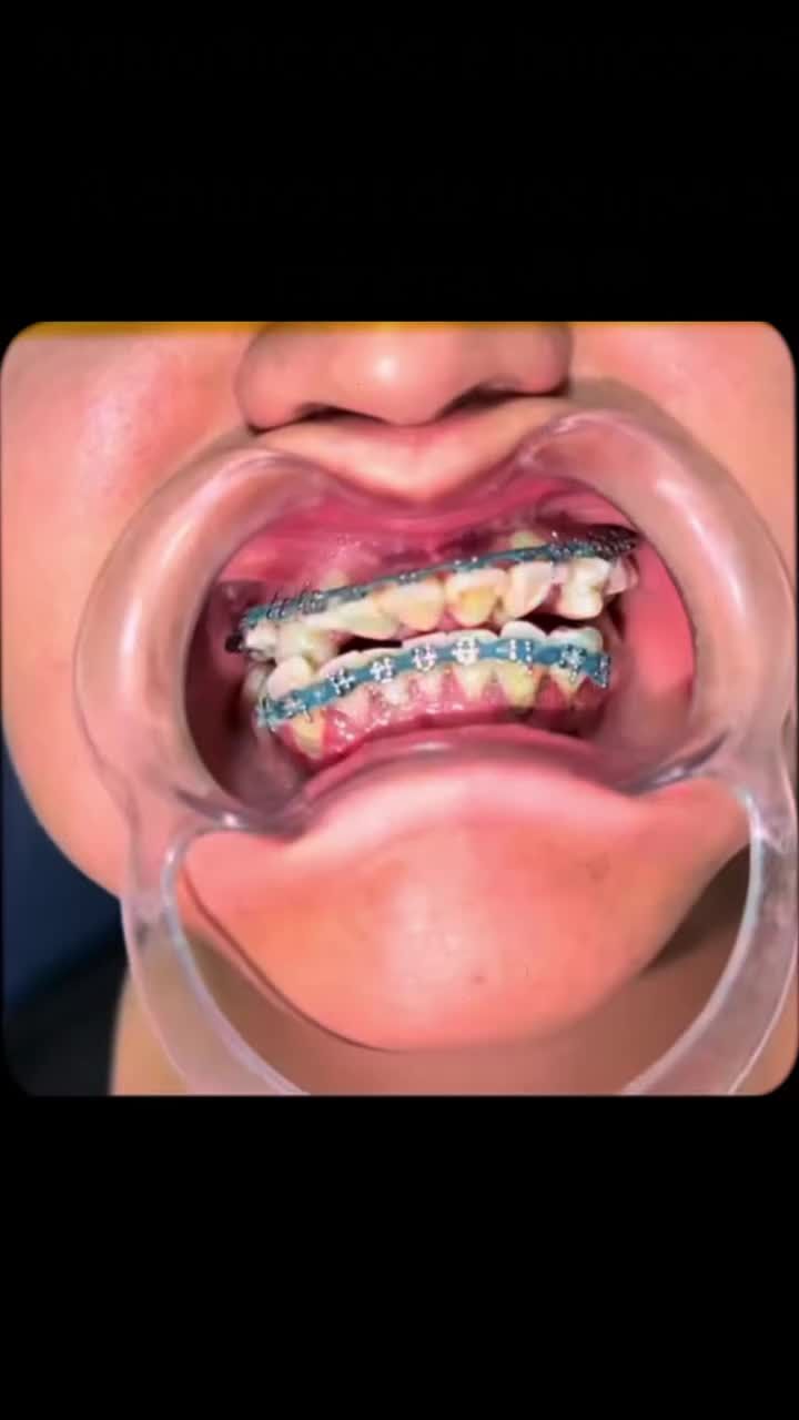 CÓ NÊN NIỀNG RĂNG GIÁ RẺ KHÔNG?